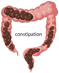 Constipation
